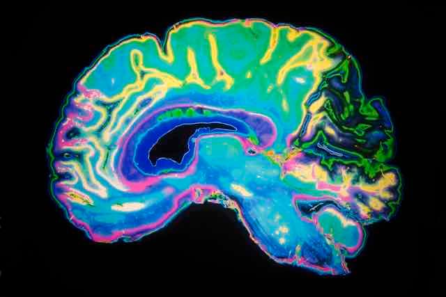 Teste de olfato x ressonância magnética: qual é o melhor para detectar declínio cognitivo?