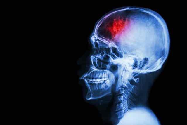 9 fatos sobre o acidente vascular cerebral (AVC)