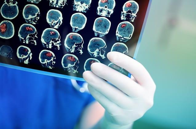 Retrospectiva PEBMED: confira as melhores novidades em neurologia
