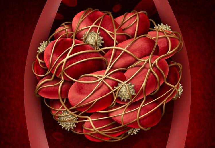 Trombectomia mecânica para oclusão aguda de artéria basilar é eficaz