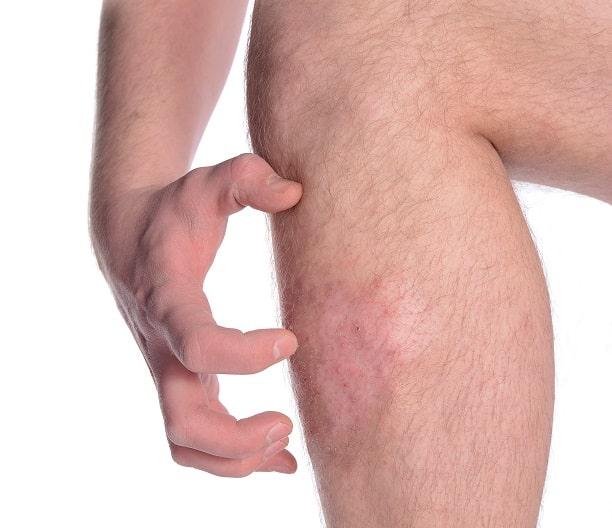 Novo tratamento para notalgia parestésica