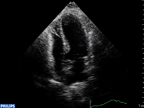 Takotsubo: Cardiomiopatia induzida por estresse