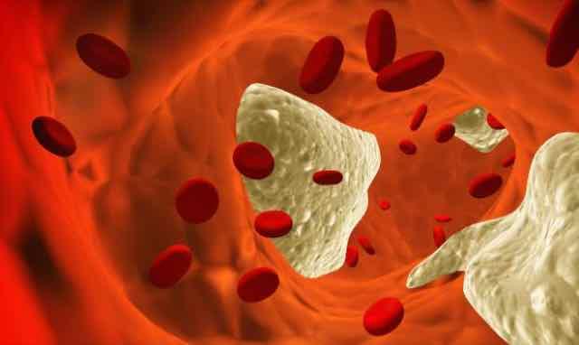 Estudo IMPROVE-IT publica resultados animadores no tratamento da dislipidemia