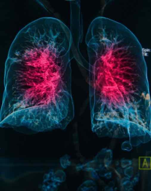 Nova estratégia de proteção pulmonar em ventilação mecânica na SDRA