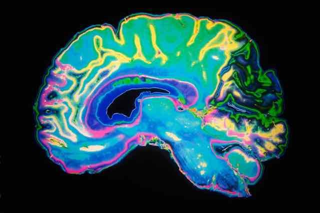 Proteína amiloide aumentada causa déficit cognitivo na população geral