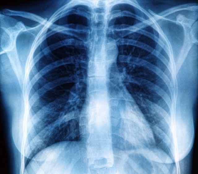 Embolia Pulmonar e Síncope: alta prevalência revela diagnóstico negligenciado