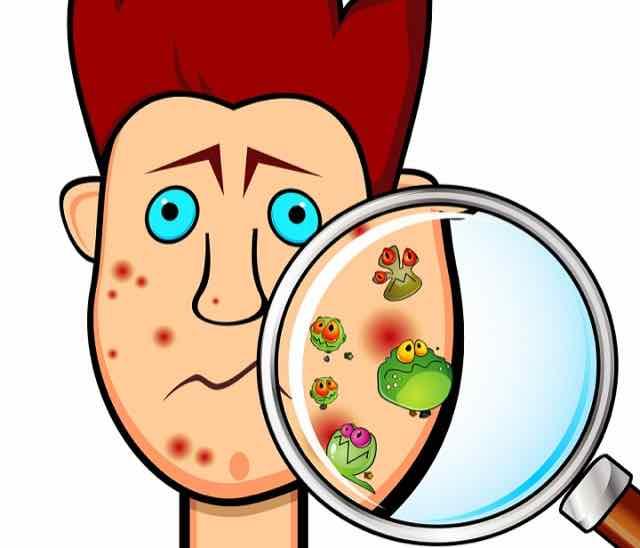 Acne: aprenda a identificar e tratar a condição dermatológica