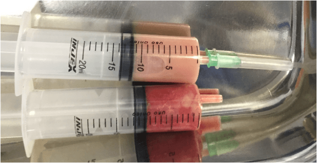 Empiema Pleural: abordagem prática