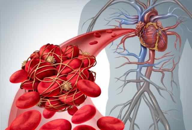 coágulo de sangue