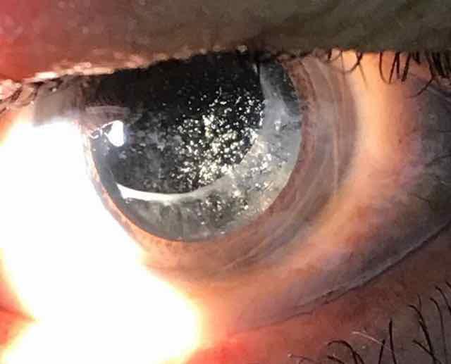 hialose asteroide em olho esquerdo de paciente pseudofácico