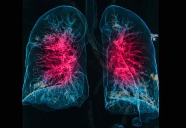 recrutamento alveolar