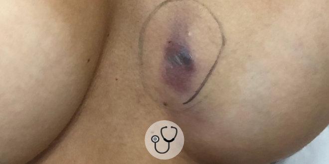 Caso clínico: complicações de mastopexia com implantes texturizados