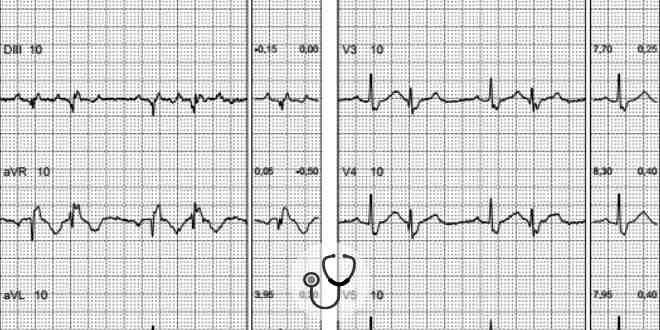 ecg caso clinico