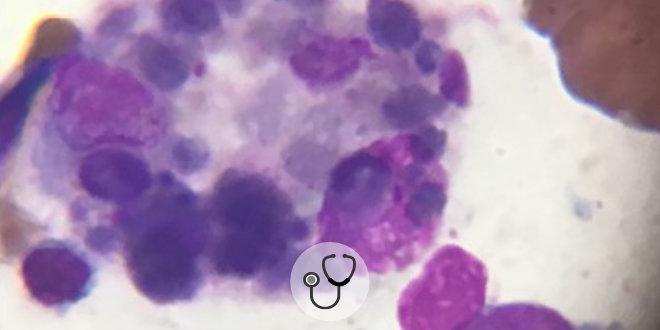 neoplasia hematológica