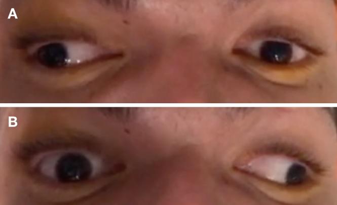 Oftalmoparesia internuclear bilateral