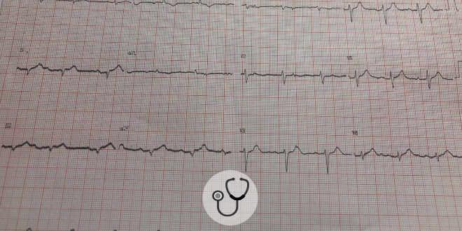 Cardiomiopatia de takotsubo