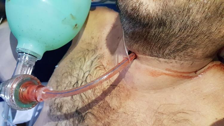 Cricotireoidostomia: abordagem cirúrgica da via aérea na emergência