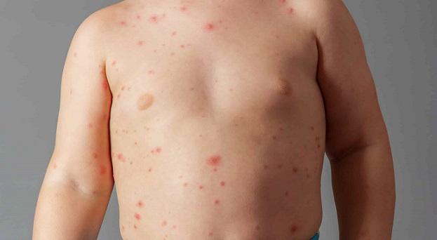 Medidas de prevenção para sarampo