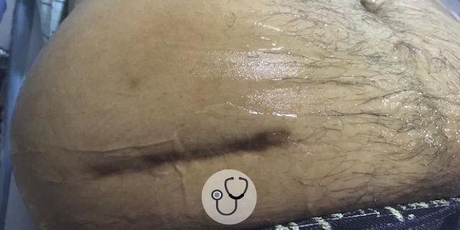 Caso Clínico: aumento localizado do volume abdominal