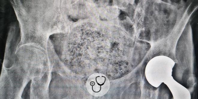 Caso clínico: mulher de 94 anos, com diarreia e hiporexia