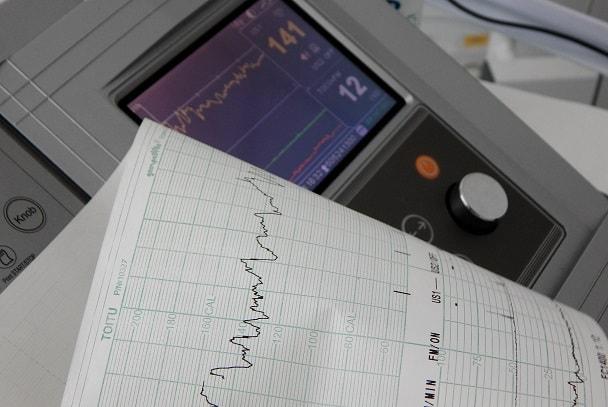 monitor ao lado de ecg de infarto