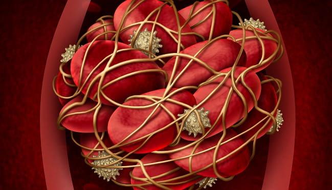 coágulo de sangue representando um tromboembolismo venoso