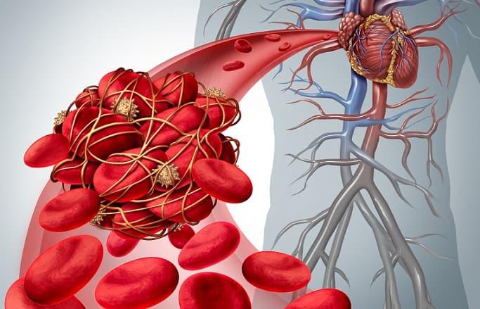 imagem computadorizada de coágulo de sangue representando trombose