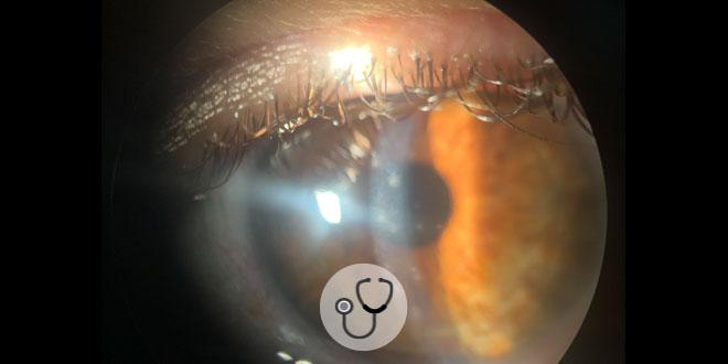 Caso clínico: paciente com hiperemia ocular e lacrimejamento