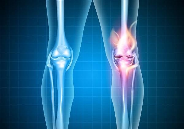 Osteoartrite: quais as principais atualizações no tratamento?