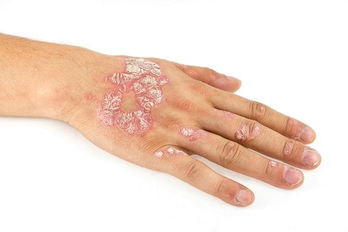 mão de pessoa com psoríase
