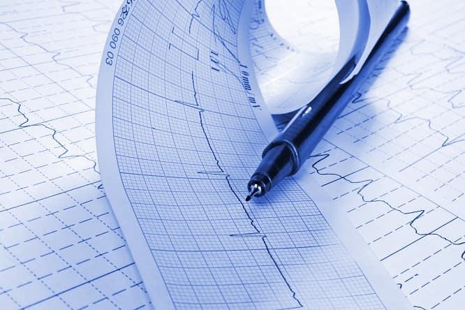 eletrocardiograma de paciente com extrassístoles ventriculares