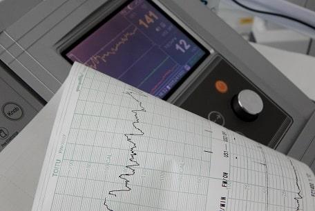 CDI subcutâneo é alternativa na prevenção de morte súbita