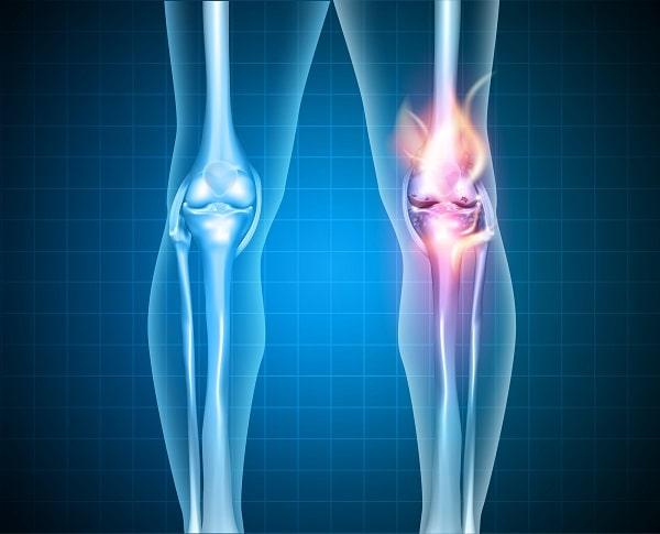 Paciente com osteoartrite de joelhos e quadril faz tratamento para bloqueio da interleucina 1-beta