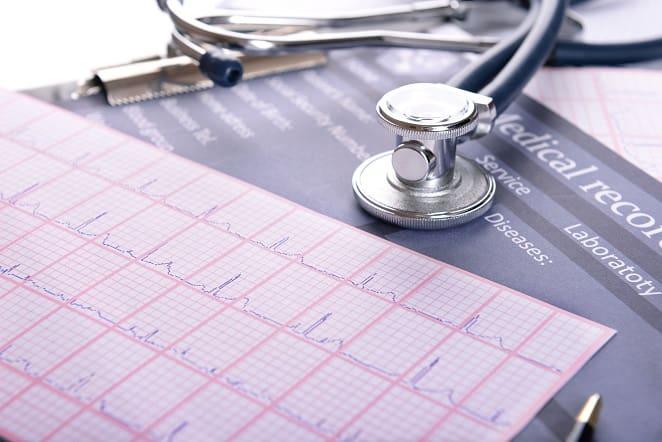 eletrocardiograma de paciente com risco de FA na prevenção de AVC, conforme apresentado no ESC 2020