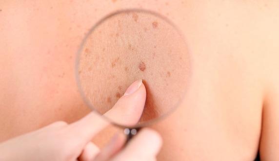 Melanoma em crianças pode ser fatal