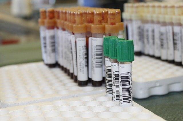 Exames de sangue de pacientes com síndromes mielodisplásicas