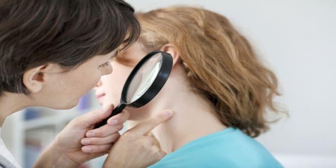 varicella zoster se manisfestando em paciente