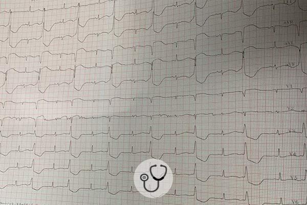 Caso clínico: Paciente 63 anos, feminina, depressiva, em uso regular de fluoxetina e alprazolam dá entrada na emergência após síncope em casa.