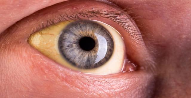 mucormicose e Covid-19