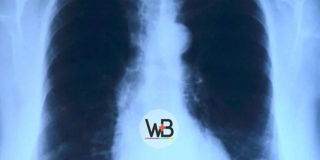 Em nossa publicação semanal de conteúdos compartilhados do Whitebook Clinical Decision vamos falar sobre pneumonia adquirida na comunidade.