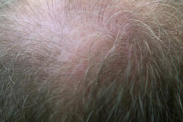 Alopecia no consultório: principais causas e tratamento
