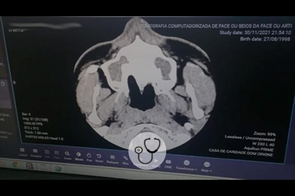 cisto intracraniano