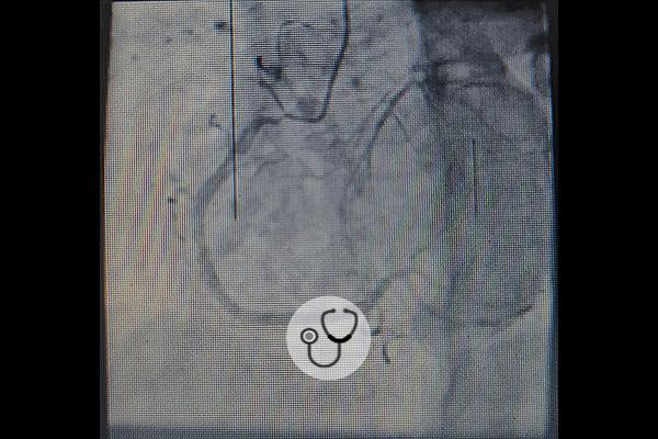 hemiparesia