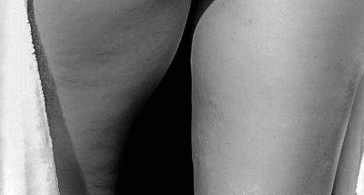 Celulite Infecciosa o que é, o que causa e como diagnosticar