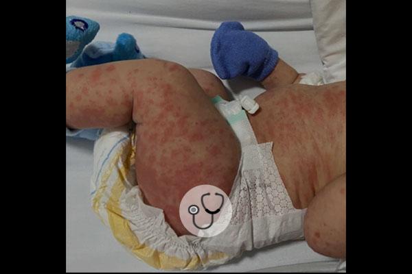 Caso clínico: Recém-nascido com “manchinhas” pelo corpo. O que será?