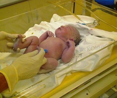 Clampeamento tardio do cordão umbilical em diabéticas pode aumentar o risco de hiperbilirrubinemia em neonatos