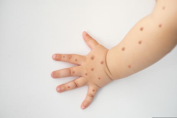 monkeypox em bebês