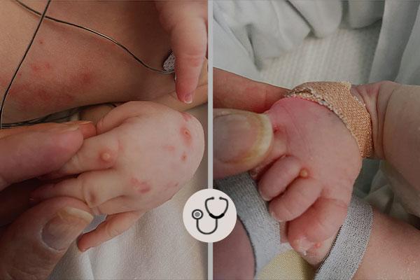 Caso clínico: Varíola dos macacos neonatal