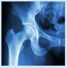 Fixação de fraturas do colo do fêmur parafuso deslizante ou canulado