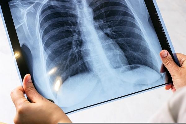 Tuberculose: Brasil registra 78 mil novos casos, um aumento de quase 5%